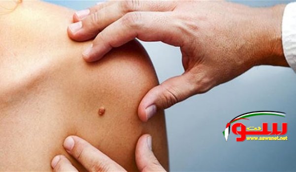 علامات تنذر بسرطان الجلد | موقع سوا علامات تنذر بسرطان الجلد | موقع سوا