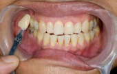 علاج تسوس الاسنان | موقع سوا 
