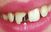  طريقة علاج الفراغات والكسور بين الأسنان!! | موقع سوا 