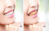 علاج صفار الأسنان | موقع سوا 